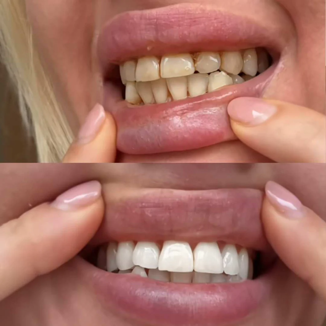LUMORA V34 Purple Whitening Strips — resultado de sonrisa blanca